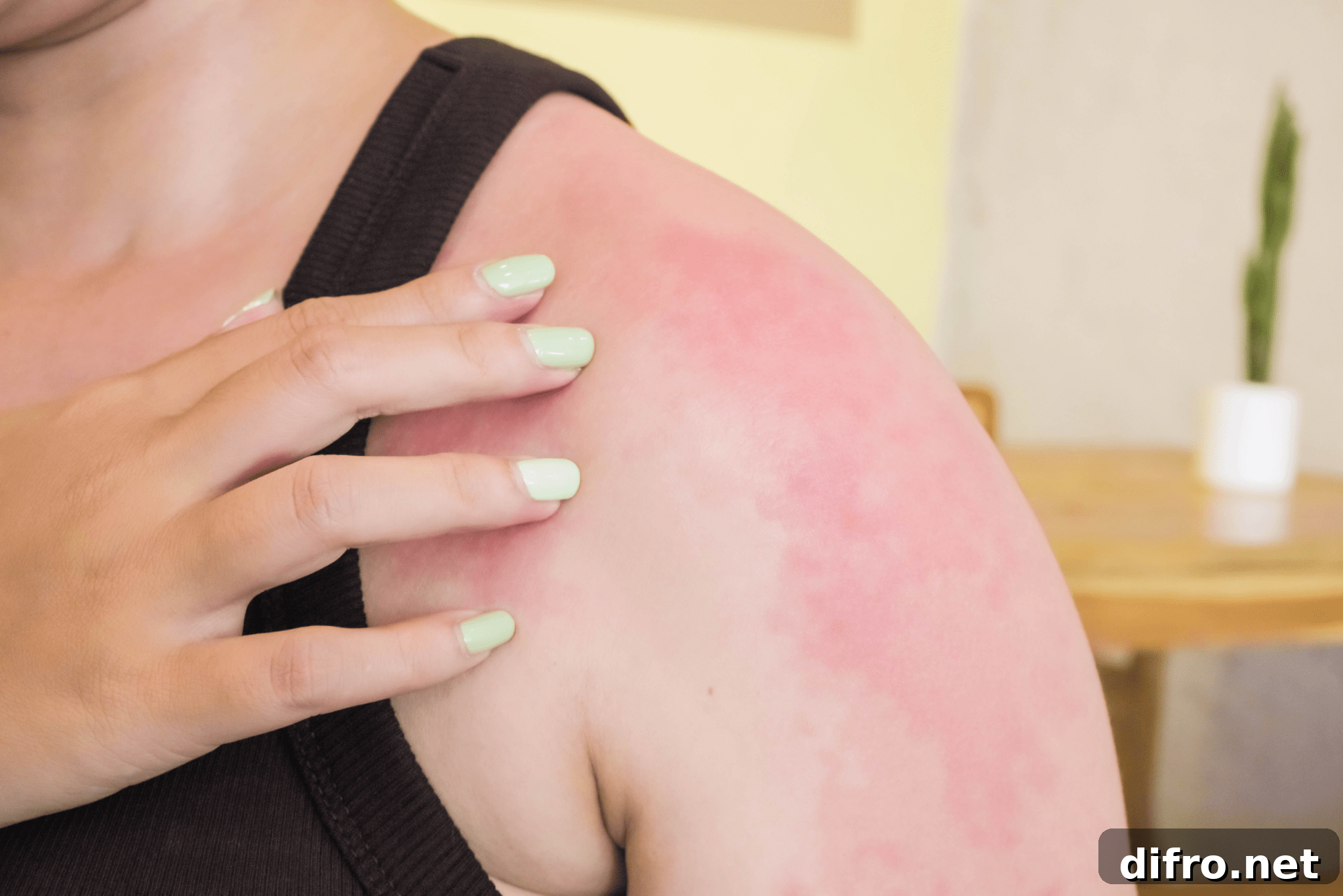 6 Smart Ways to Reuse Tea Bags for Home, Garden and Beauty 6 A woman with red skin on her shoulder.